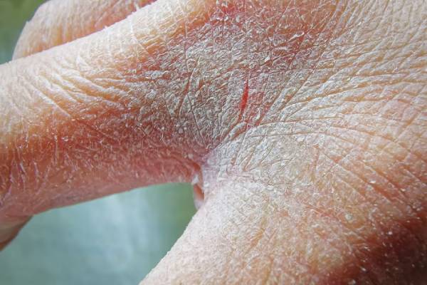 پوسته پوسته شدن دست